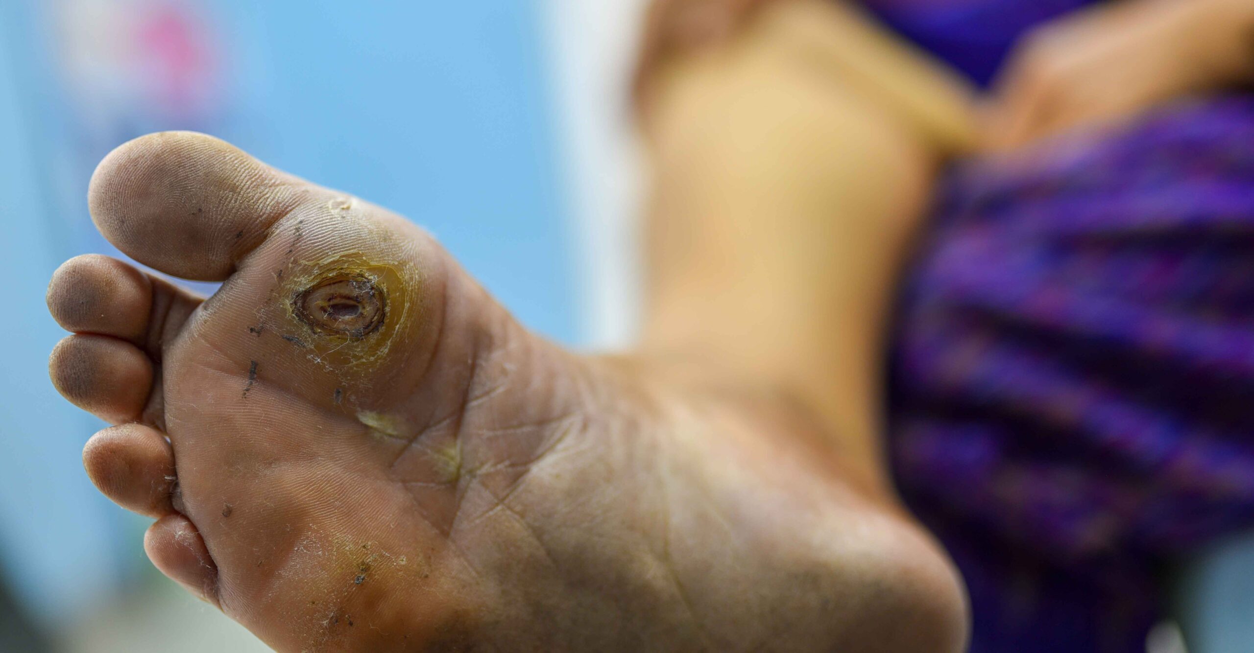 Diabetic Foot Ulcer Management Proven Strategies for Prevention and Healing