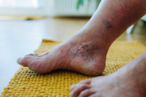 Comprehensive Diabetic Foot Ulcer Management Strategies for Prevention and Healing