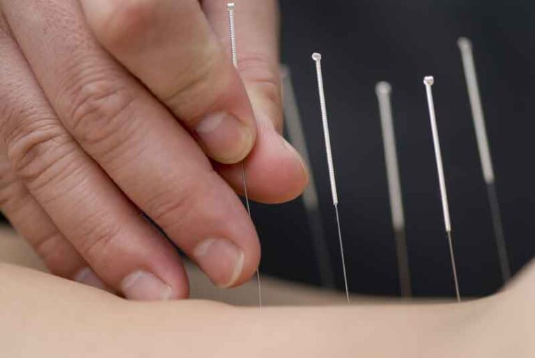 Dry Needling Treatment Fishers Effective Relief for Muscle Pain and Injury Recovery